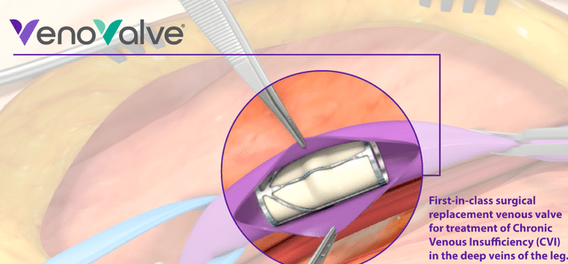 VenoValve